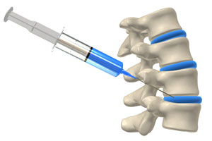 needle in spine, spine center Savannah, Spine surgery second opinion Savannah, spine surgeon Savannah, Second opinion for spine surgery Savannah, Laser spine surgery Savannah, Minimally invasive spine surgery Savannah, Home remedies for back pain Savannah, nonsurgical treatment for back pain Savannah, Herniated disc Savannah, spinal injections Savannah, Artificial disc replacement Savannah, neurological institute, neurological problems Georgia, neurosurgery Georgia, neurosurgery hilton head, pediatric neurosurgery Georgia, spine surgeon Georgia, Herniated disc Georgia, Spine surgeon second opinion Georgia, Minimally invasive spine surgery Georgia